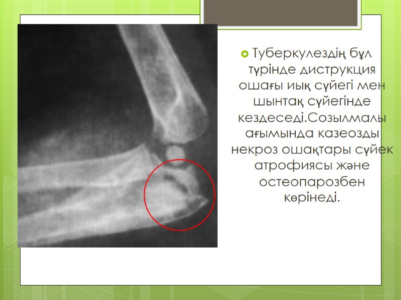 Туберкулездің бұл түрінде диструкция ошағы иық сүйегі мен шынтақ сүйегінде кездеседі.Созылмалы ағымында казеозды некроз